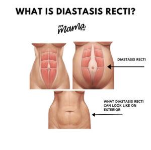 What is Diastasis Recti?  Here is an image of what it looks like