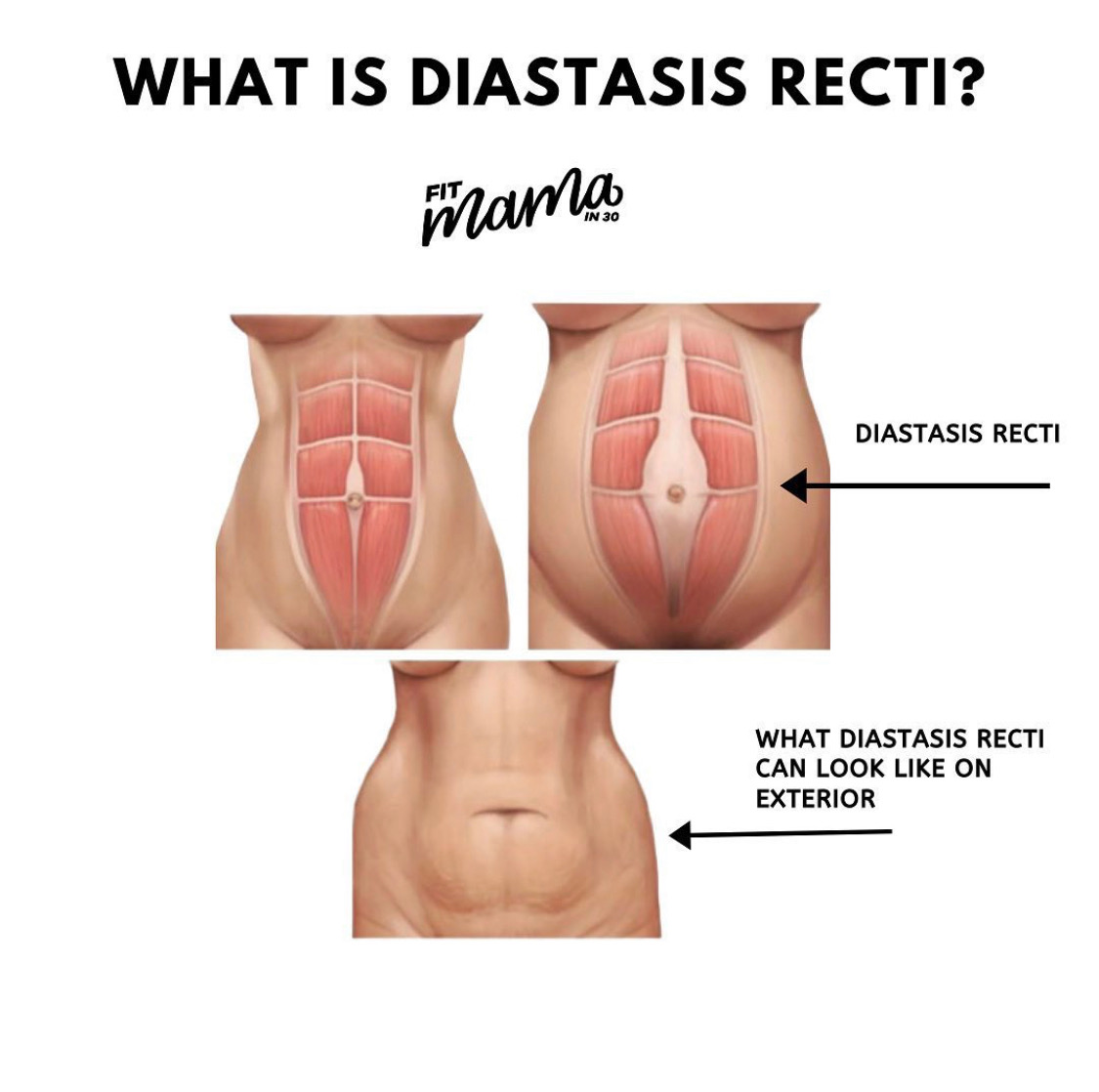 Read more about the article Diastasis Recti: How to Recover Postpartum Ab Separation